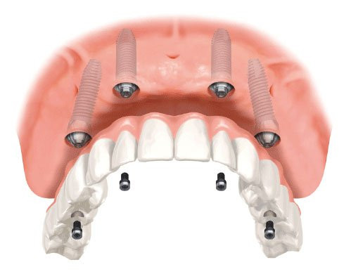 implantes dentales torremolinos