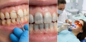 Tipos de manchas dentales más comunes y cómo eliminarlas
